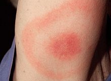 Erythema_migrans_-_erythematous_rash_in_Lyme_disease_-_PHIL_9875